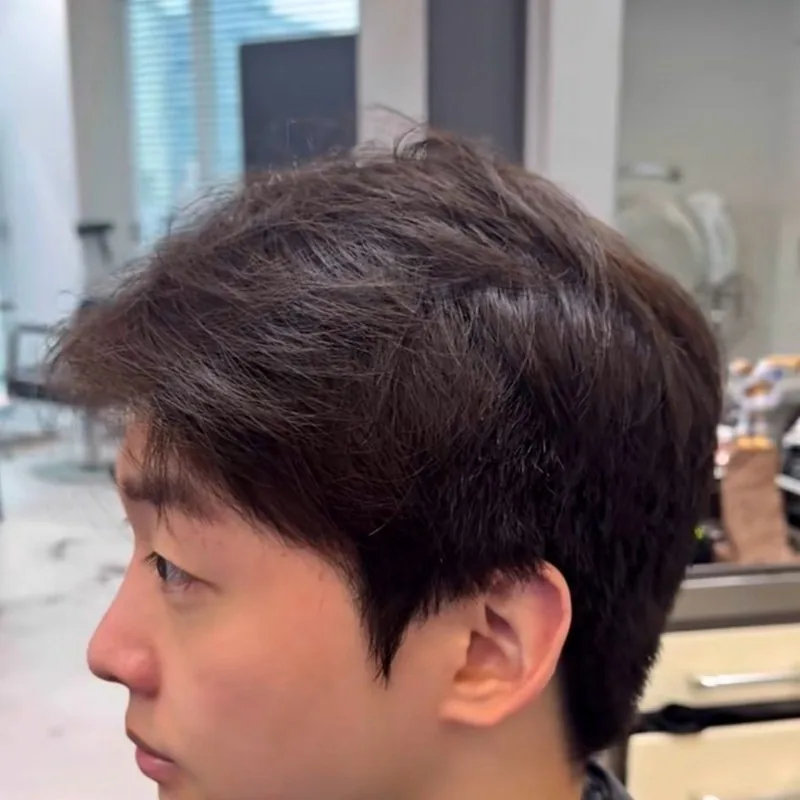 라인과 질감의 변화 시술 전