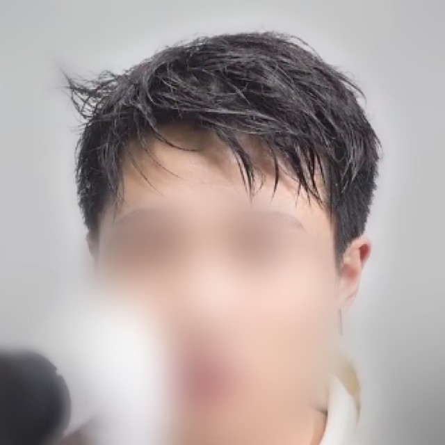 시술 전 머리