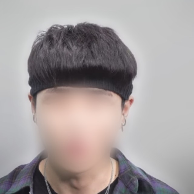 시술 전 머리